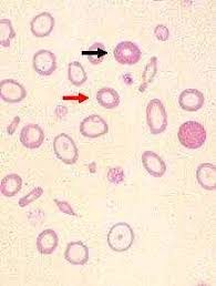 hypochromic, microcytic anemia.