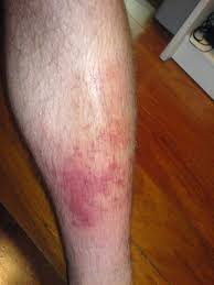 cellulitis