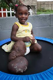  Klippel-Trenaunay-Weber syndrome 