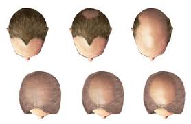 male baldness organin
