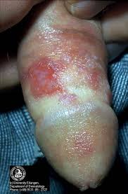 Foto di herpes - is
