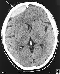 epidural hematoma adjacent to 