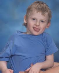 with Angelman Syndrome.