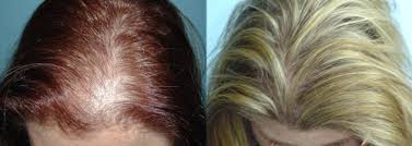 top&nbsp;hair&nbsp;&nbsp;loss&nbsp;medication