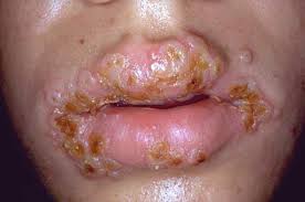 Foto di herpes - photobucket