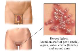 Foto di herpes - coldsoreblisters