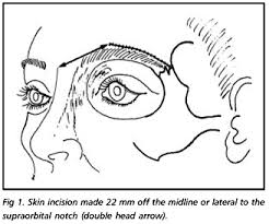 The orbicularis oculi muscle is 
