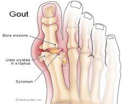 Gout Pain