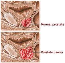 Hormone Replacemant Therapy(HRT)