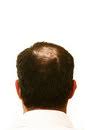 female hair loss solution
