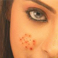 http://tbn2.google.com/images?q=tbn:RYumlJs80fao1M:http://www.keyaaromatherapy.com/images/pimples%2520Comp%25201.gif