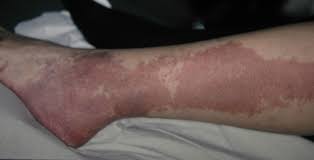 Klippel-Trenaunay syndrome