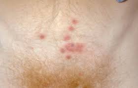 Genital Herpes