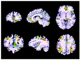 Anxiety Disorder: Obsessive-Compulsive Disorder