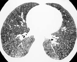 Idiopathic pulmonary hemosiderosis