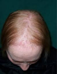 recipe for hair loss to thicken hair