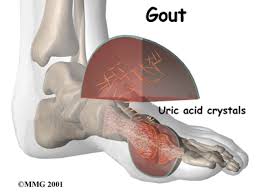 Gout Symptoms