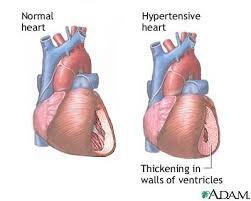 Hypertensive heart disease 