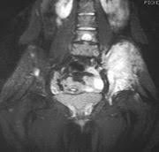 slice showing Ewings sarcoma of