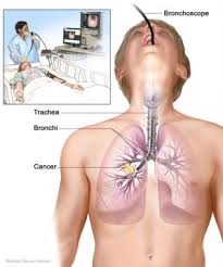 الجهاز التنفسي في الانسان ويا لها من قدرة الخالق 300px-Bronchoscopy1
