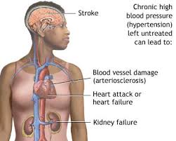  hypertensive heart disease 
