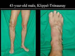  with Klippel-Tr�naunay syndrome.