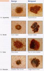 cost of outpatient mole removal