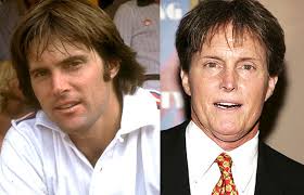 Bruce Jenner Plastic Surgery - The